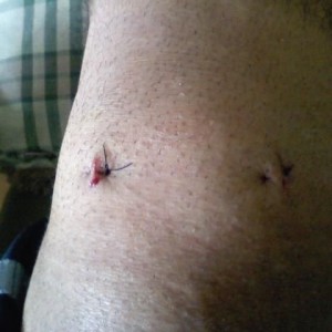 Knee Arthroscopy. Cant wait to feel no more pain