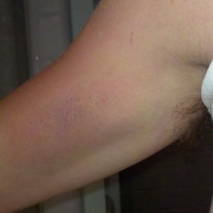 From my new shotty. This is the bruising that bled down from my shoulder. D