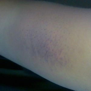 Lol I woke up this morning to find my arm purple
