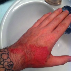 :woot: The last of the burnt flesh fell off and it appears to be healing.