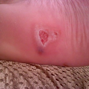 spider bite on the bottom of my foot