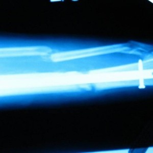 pin