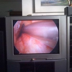Wtf, they filmed my surgery? Pretty cool, I guess, haha.