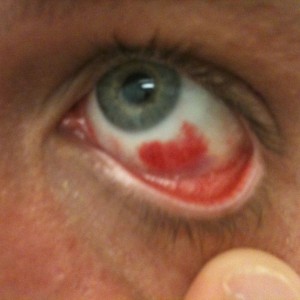 Ruptured one in my other eye, help me