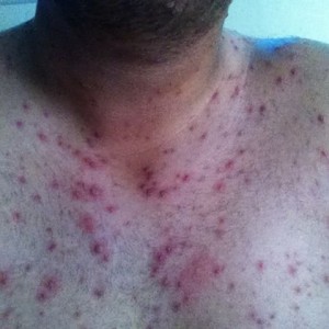 Chicken pox @ 21... Such a shitty feeling :(