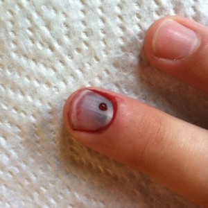Needle was too sharp. Too small of a hole. Had to push it real far in