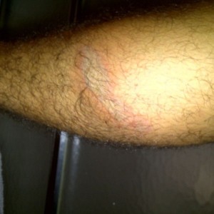 2nd degree burn on my leg from the fourwheeler. Changed into shorts and did