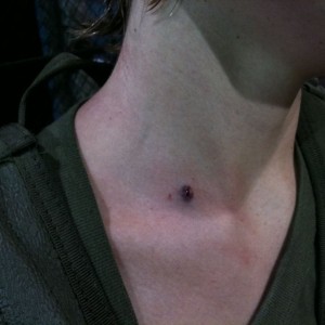One kid took it in the neck during airsoft, some guys had way too powerful 