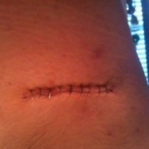 Surgery yesterday! Both sides