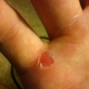 Ouch. Feels WONDERFUL
