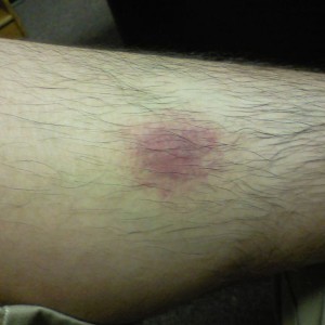 3 day old spider bite. It was worse yesterday