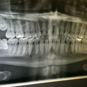 Pic of my teeth before they pulled my wisdom teeth out