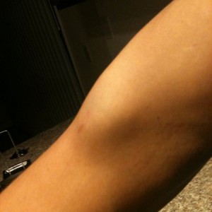 Other arm