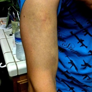 This is how my friends arm looks 4 weeks after I did this: