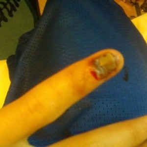 I broke my damn finger