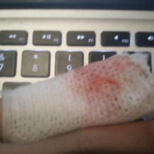 I broke my finger 3 days ago and it is still bleeding. I think i might need