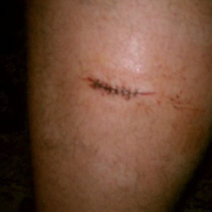Second time getting stitched ever