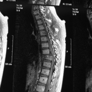 broken back