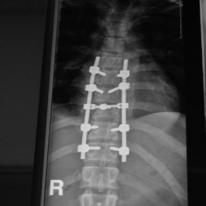 broken back