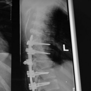broken back