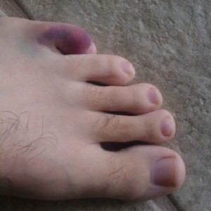 Stubbed my toe yesterday..... Surprised i dont just have bloody nubbs at th