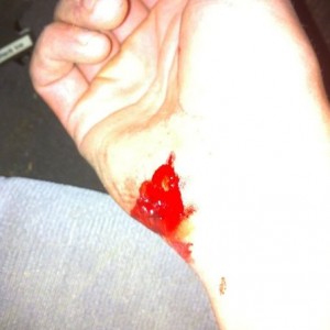 Did this to my hand and broke my right arm. Got thrown off a golf cart on c