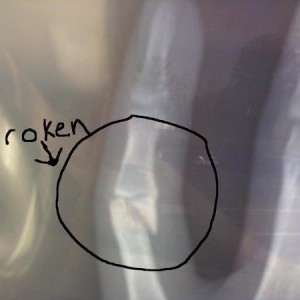 broken_finger