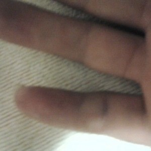 Jammed my pinky playing basketball last night, I can bend it a little bit b