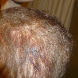 Christmas_Injury_006