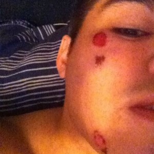 Gi burn from the other day. Went to pat dry my face after a shower and the 