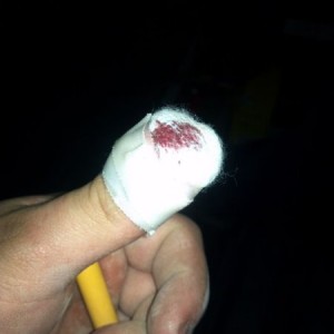 Smashed my thumb cut it open :(