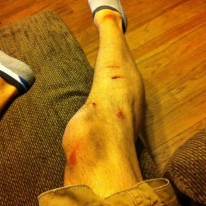 Mtn bike wreck... No fun