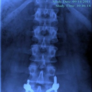 My 2011 surgery