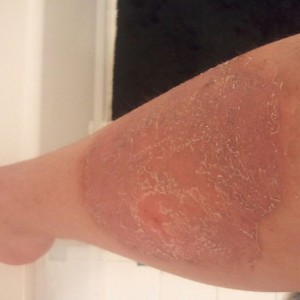 Leg after scrub