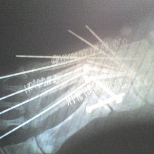 broken foot