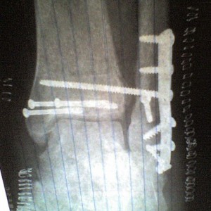 broken foot