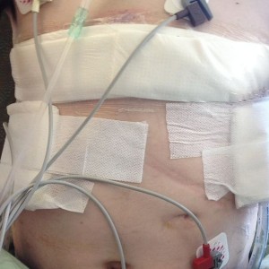 Double Lung Transplant.