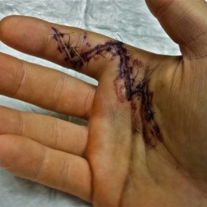 stitches
