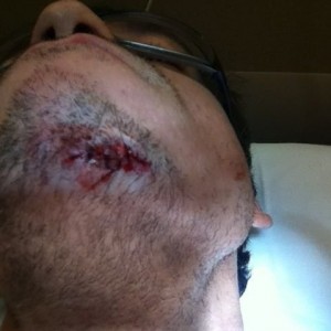 Fresh stitches