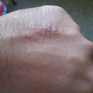 Ran into poison ivy somewhere. I want to belt sand it off! F!