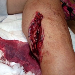 Father in law had a chainsaw accident. :eek: