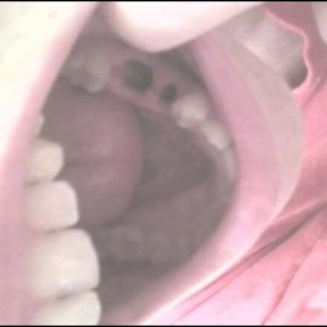 Yanked teeth