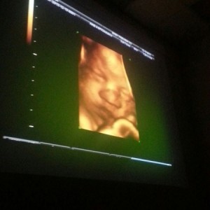 3D ultrasound of our soon to be 2nd daughter.