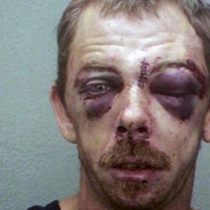 Black_eye