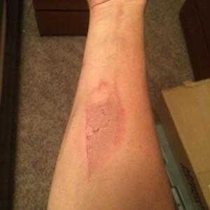 Burnt my arm. Again.