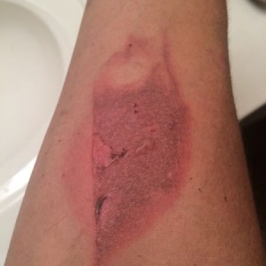 Burn day 2. How am I gonna get this healed in a week so I can be on the lak