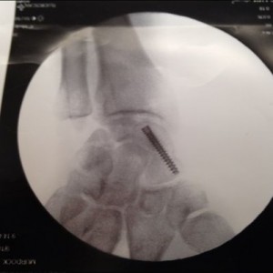 Fuck you wrist