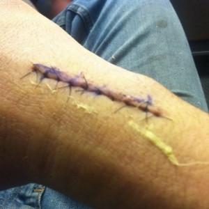 2 weeks after surgery