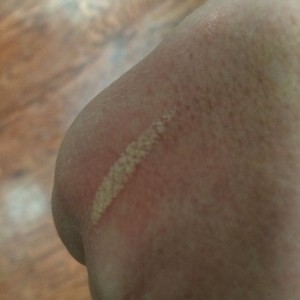 Bad pic but I burned the crap out of my hand. (The light colored line) I ki