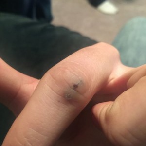 Ground into my finger last summer with a flap disk. Didn't clean it ou